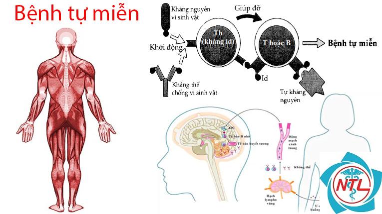 bệnh thận do bệnh tự miễn - Image 4