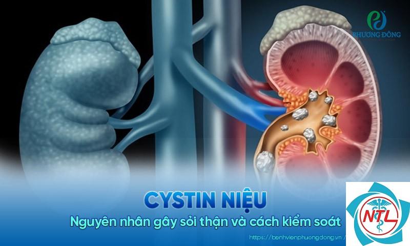 bệnh thận do cystin - Image 2