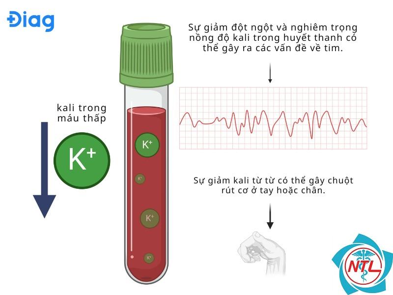 bệnh thận do giảm kali máu - Image 4