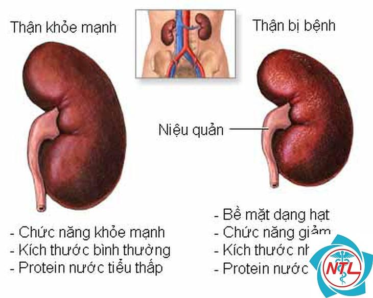 bệnh thận do hóa chất - Image 2