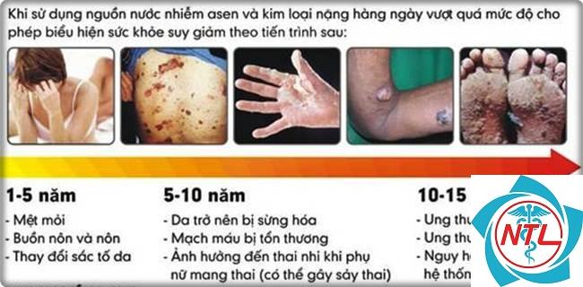 bệnh thận do kim loại nặng - Image 3