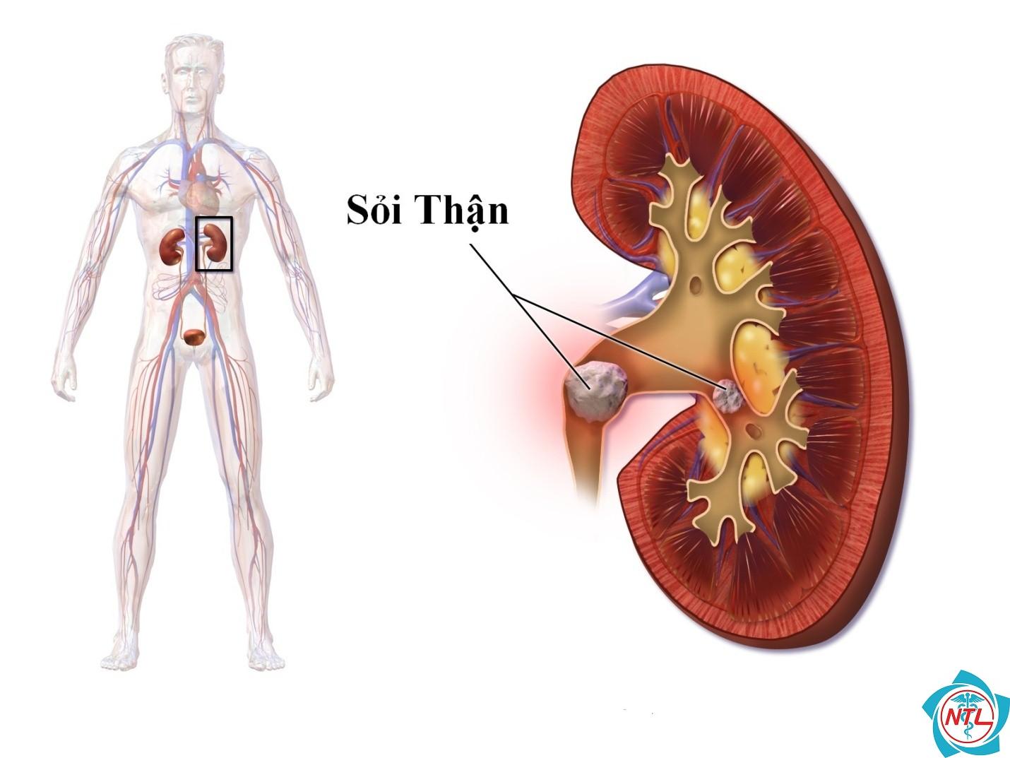 bệnh thận do oxalat - Image 2