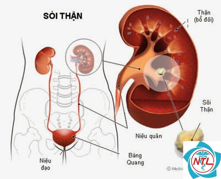 bệnh thận do oxalat - Image 3