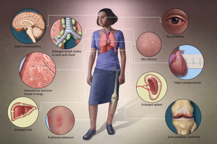 bệnh thận do sarcoidosis - Image 2