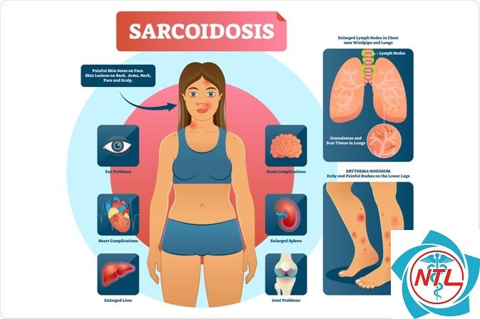 bệnh thận do sarcoidosis - Image 4