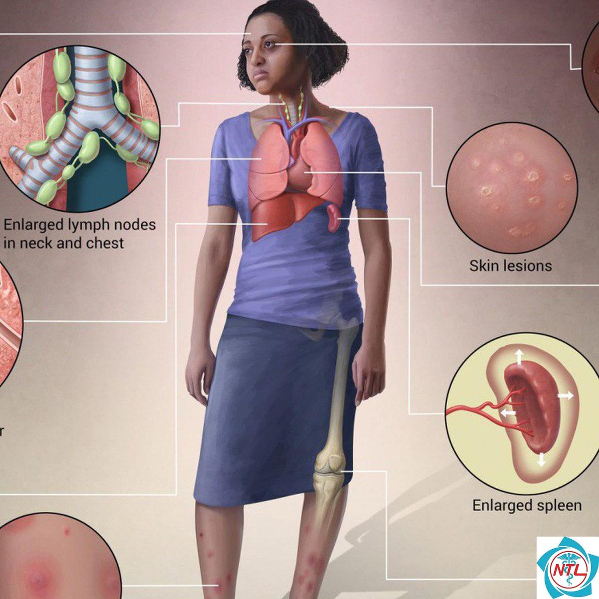 bệnh thận do sarcoidosis - Image 5