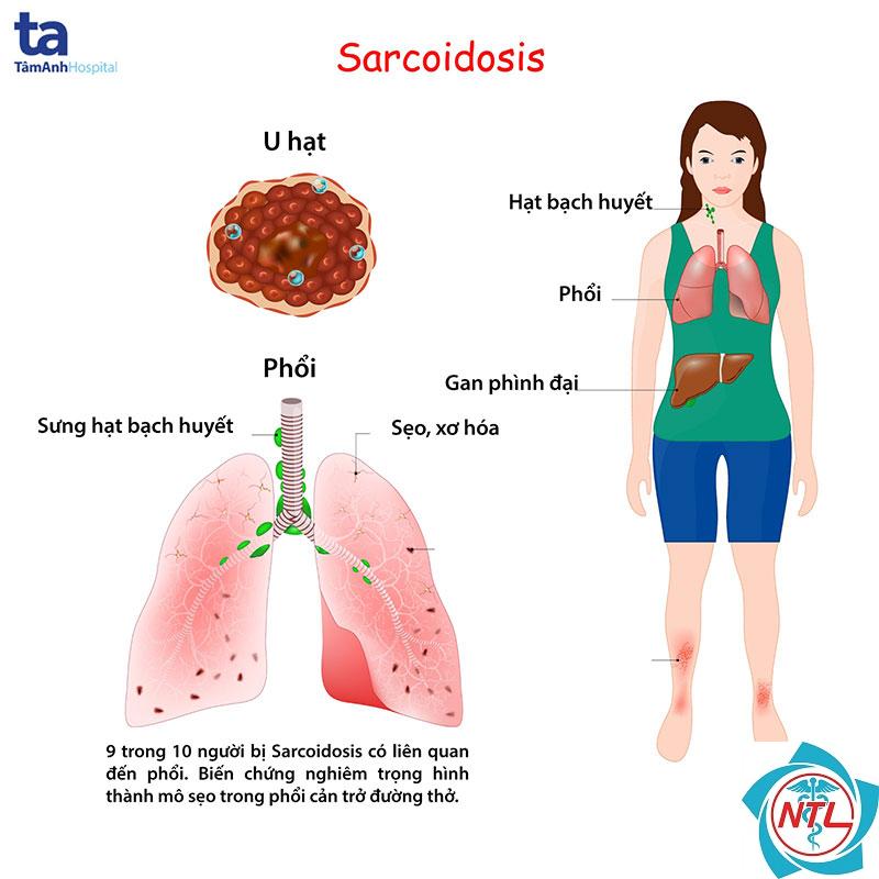 bệnh thận do sarcoidosis