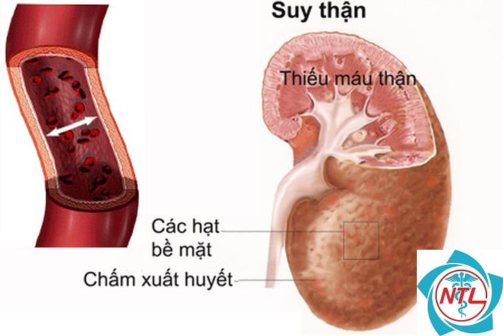bệnh thận do thuốc chống viêm - Image 1