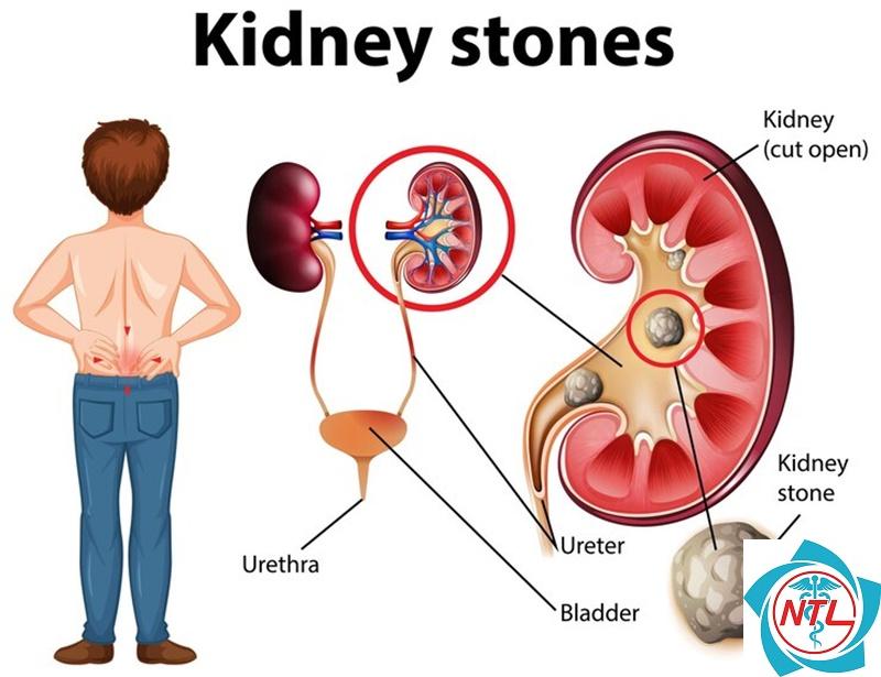 bệnh thận giai đoạn cuối ở người cao tuổi