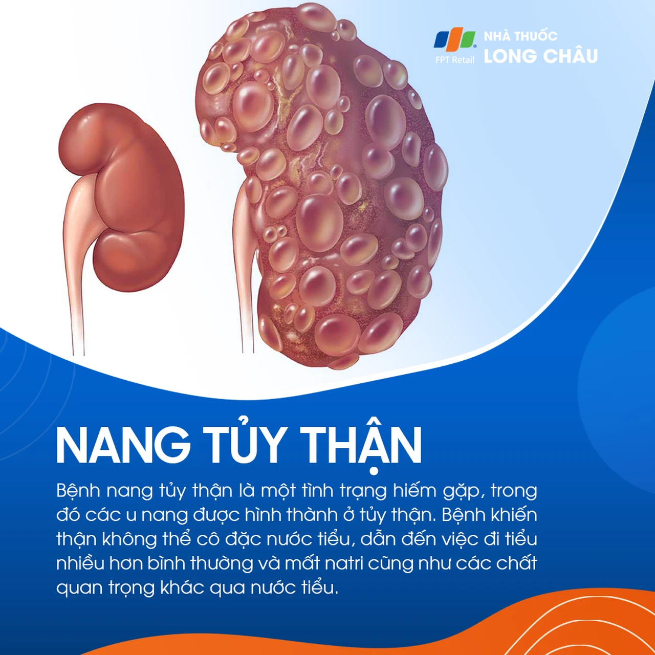 bệnh thận nang tủy - Image 2