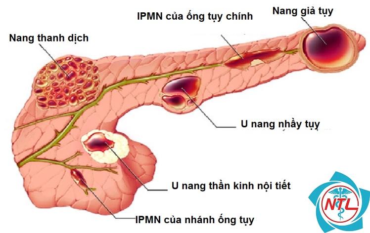 bệnh thận nang tủy - Image 4