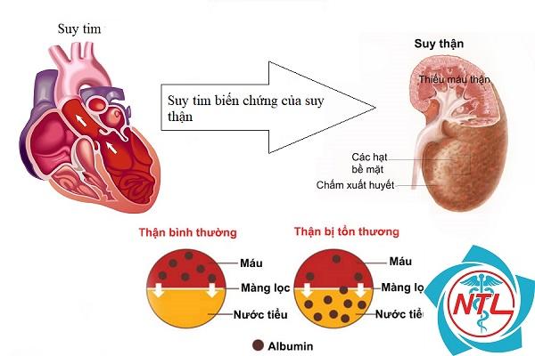 bệnh tim mạch do bệnh thận