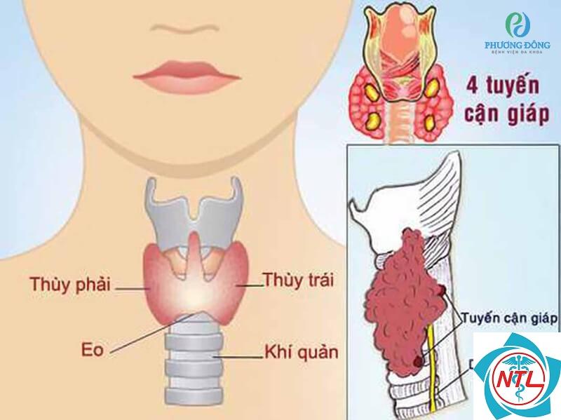 cường cận giáp do bệnh thận - Image 3