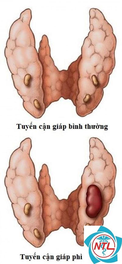 cường cận giáp do bệnh thận