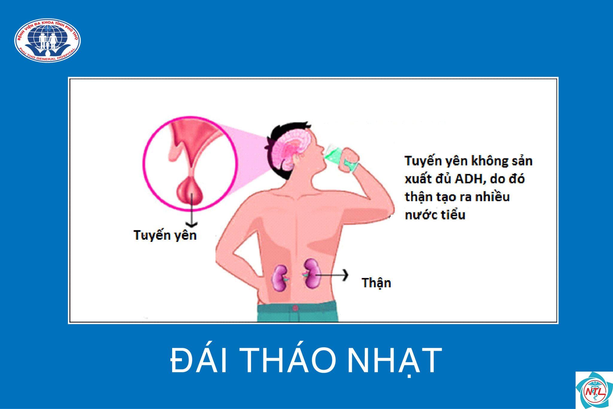đái tháo nhạt do thận - Image 4