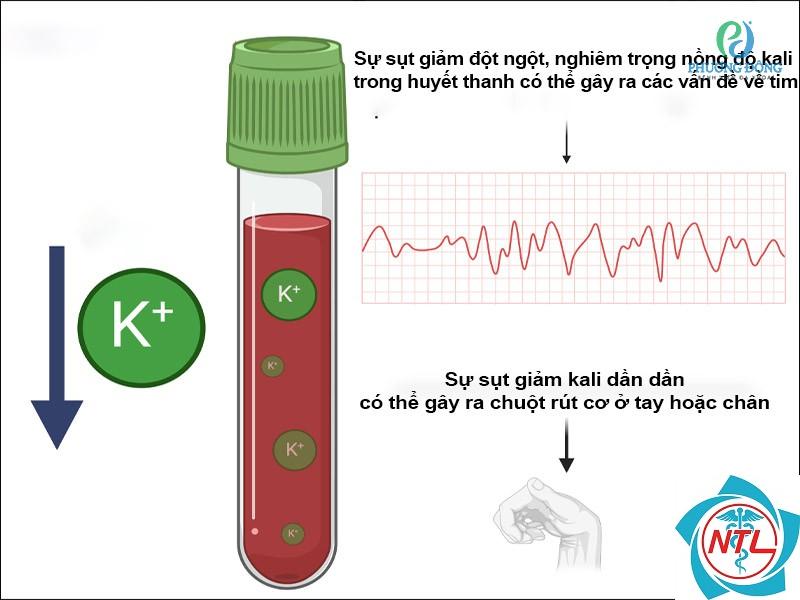hạ kali máu do bệnh thận - Image 4