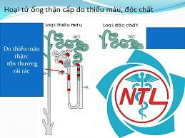 hoại tử ống thận cấp - Image 3