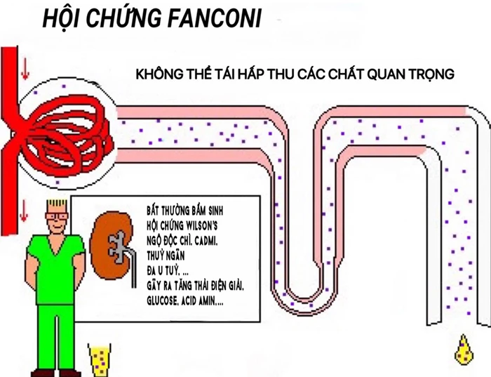 hội chứng Fanconi - Image 2