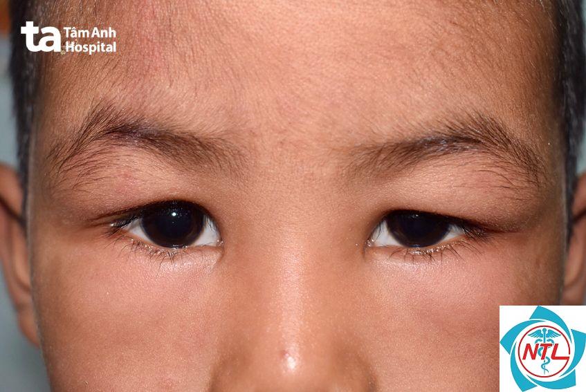 hội chứng thận hư ở trẻ nhỏ - Image 2