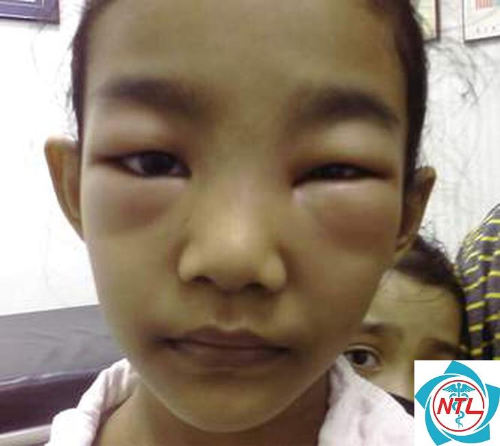 hội chứng thận hư ở trẻ nhỏ - Image 3