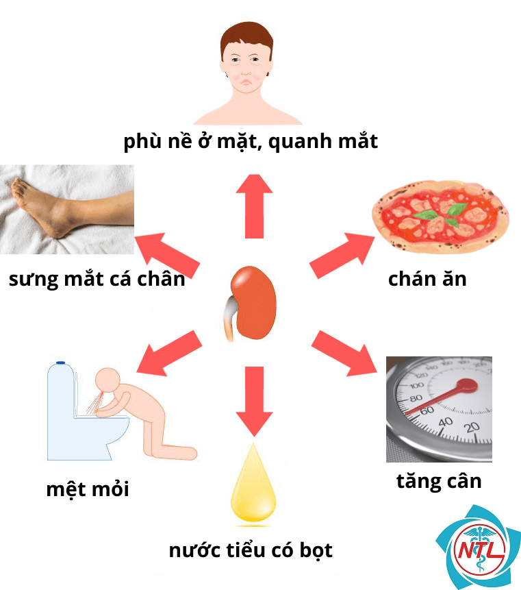 hội chứng thận hư thứ phát - Image 2