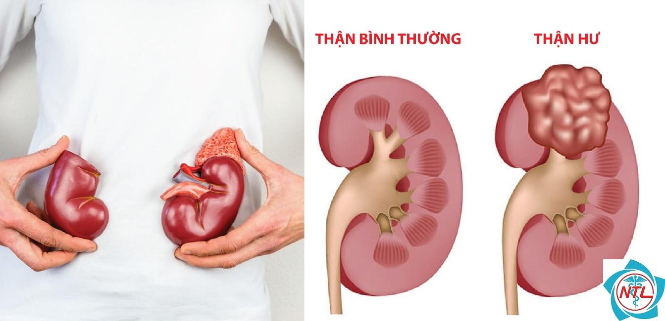 hội chứng thận hư thứ phát - Image 3