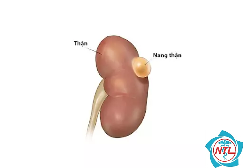 nang cạnh thận - Image 3