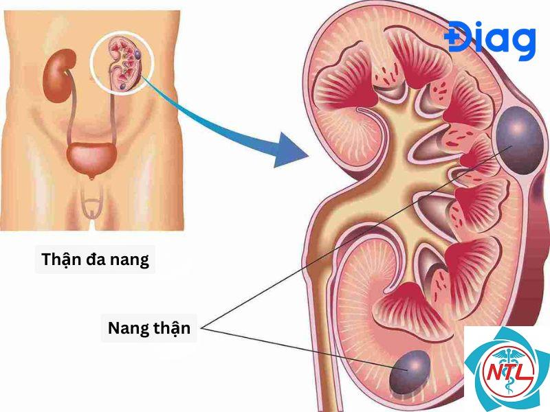 nang quanh thận