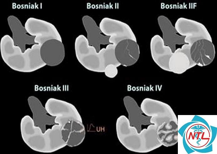 nang thận phức tạp Bosniak - Image 2