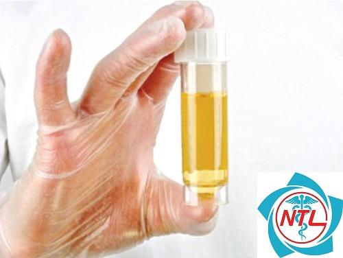 protein niệu chọn lọc