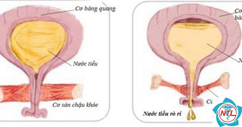 rối loạn cô đặc nước tiểu