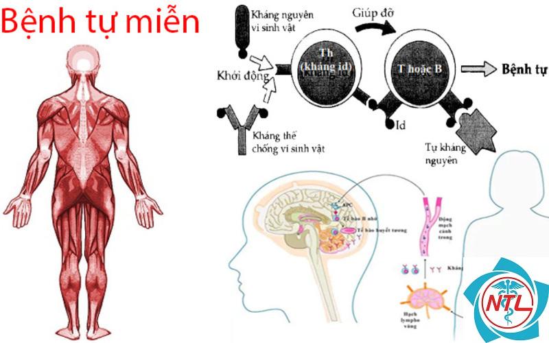 suy thận cấp do bệnh tự miễn - Image 4