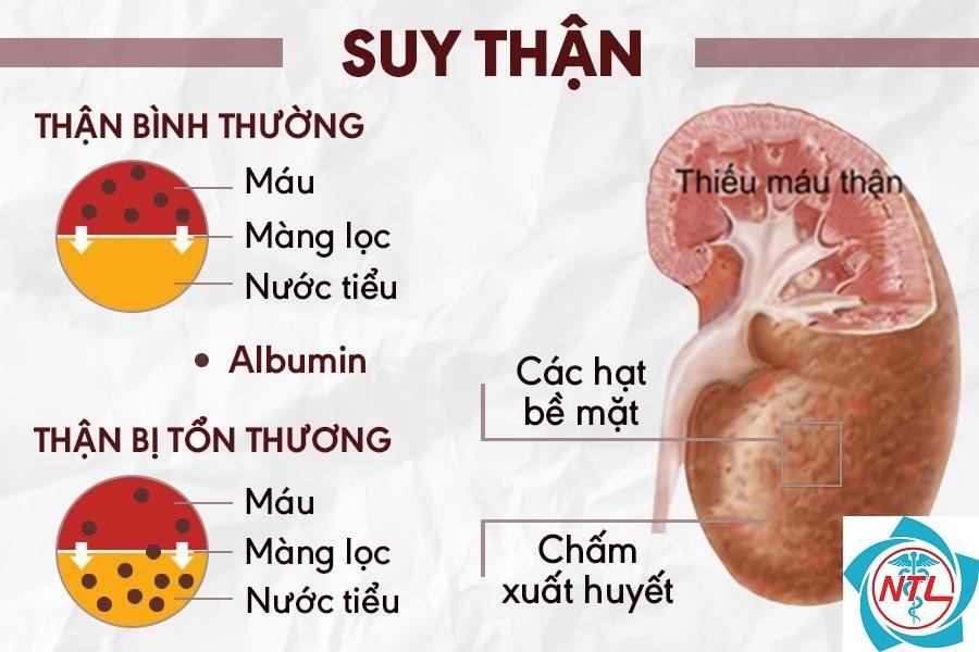 suy thận cấp do mất máu - Image 2