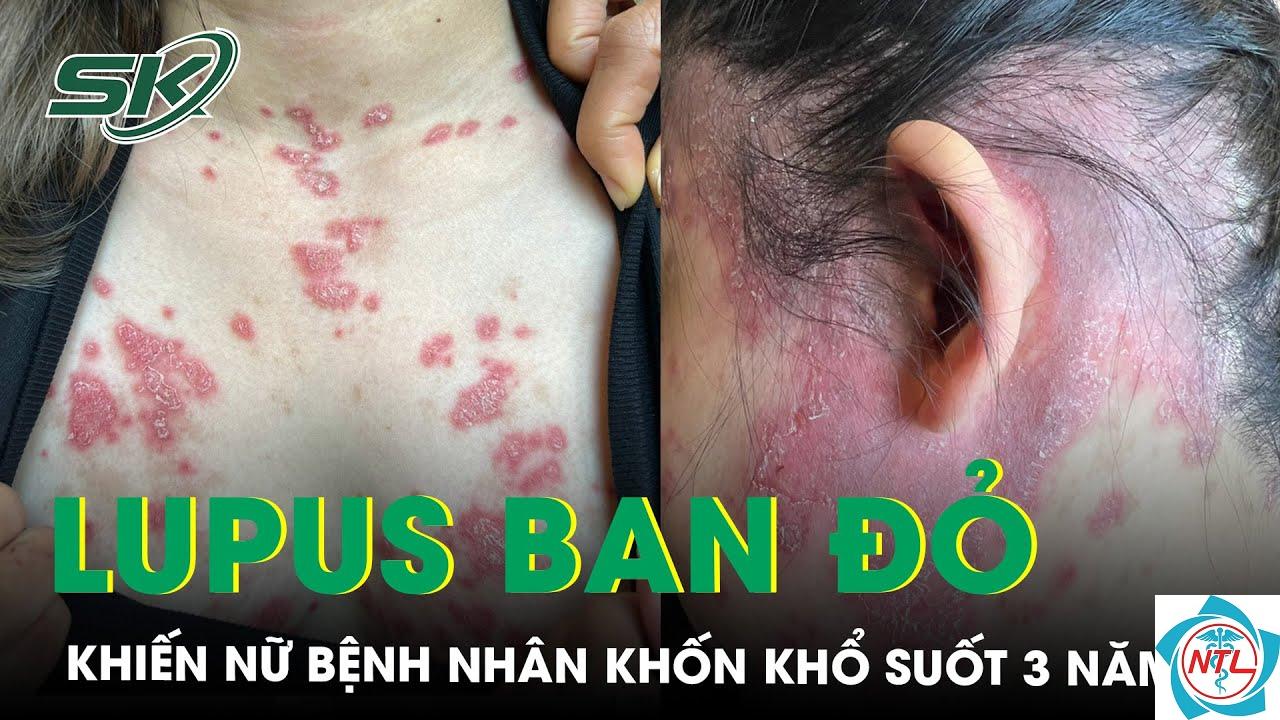 suy thận mạn do lupus - Image 4