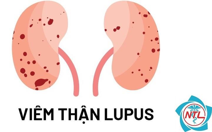 suy thận mạn do lupus - Image 5
