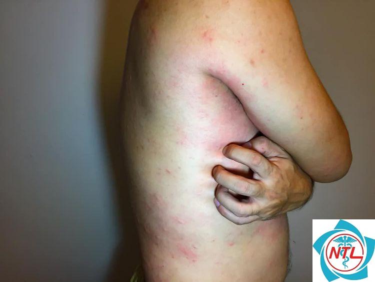 suy thận mạn do lupus