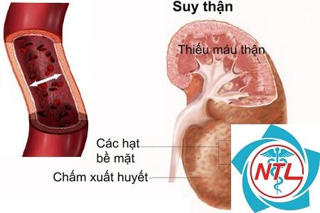 suy thận mạn do tắc nghẽn - Image 4
