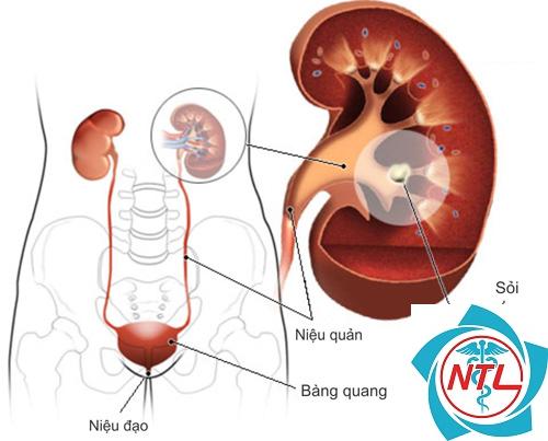 tăng acid uric máu do thận - Image 3