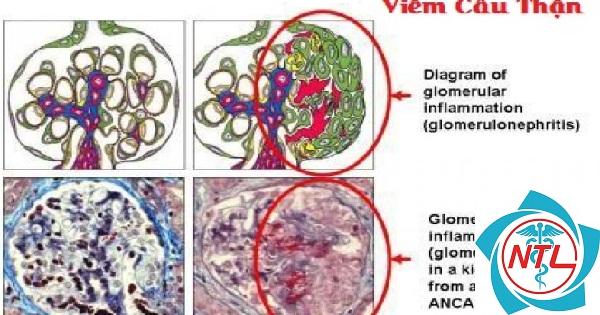 viêm cầu thận do ANCA - Image 2
