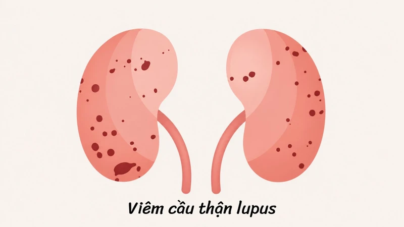 viêm cầu thận do lupus - Image 4