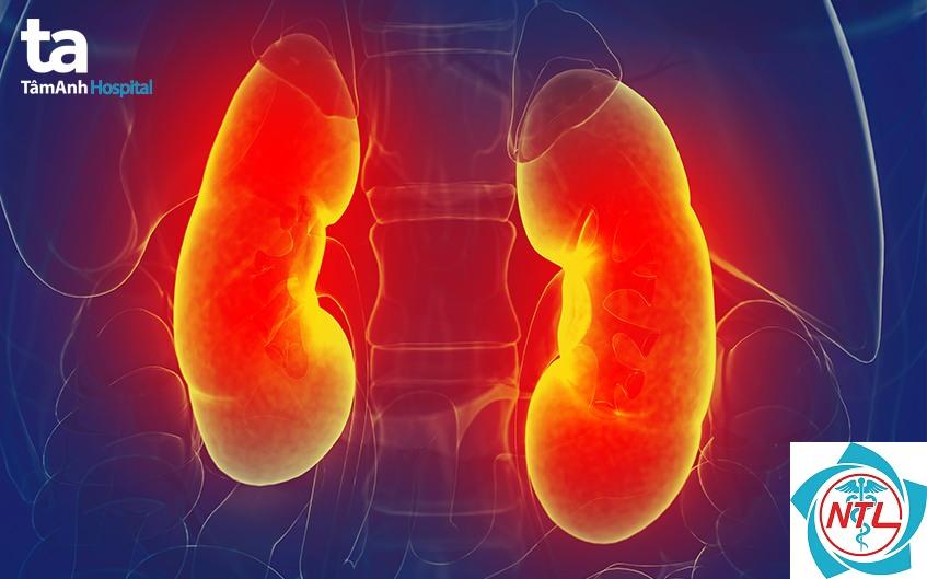 viêm cầu thận do lupus