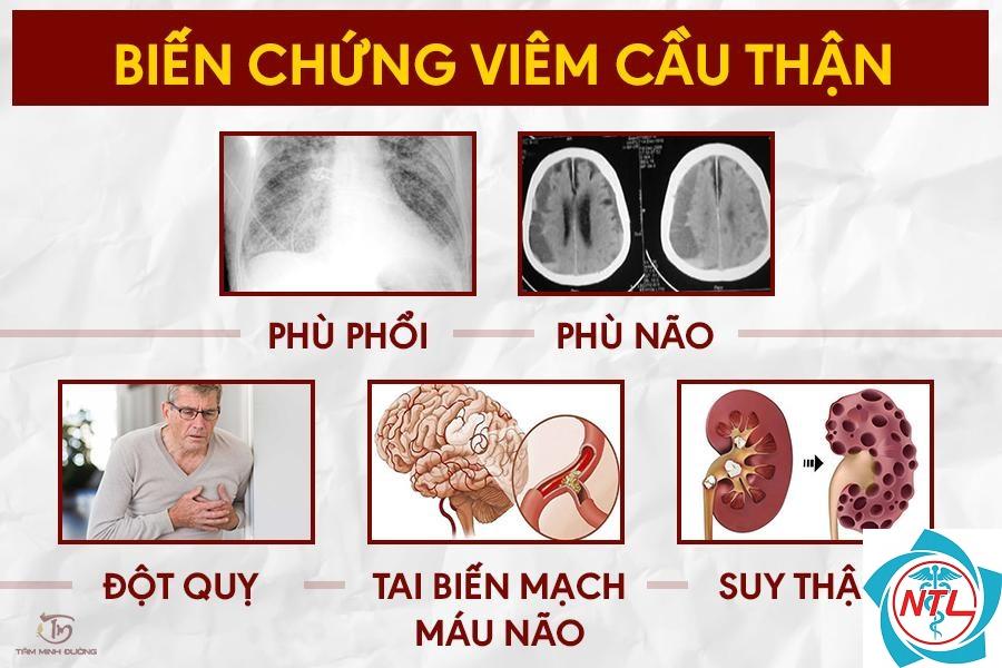 viêm cầu thận do nhiễm trùng - Image 3