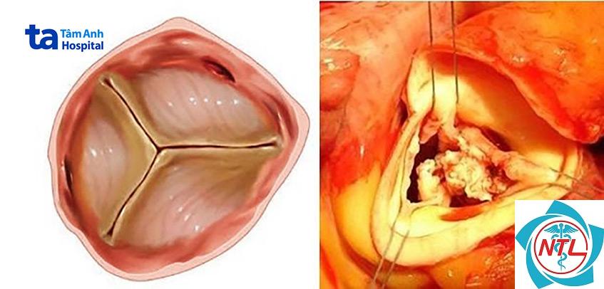 viêm cầu thận do viêm nội tâm mạc - Image 2