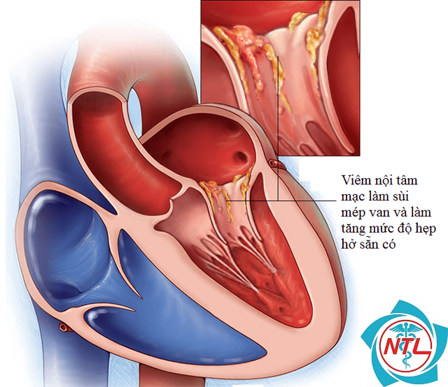 viêm cầu thận do viêm nội tâm mạc - Image 3