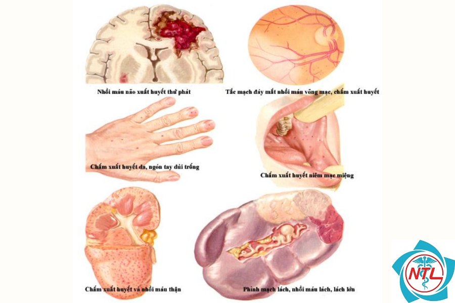 viêm cầu thận do viêm nội tâm mạc - Image 4