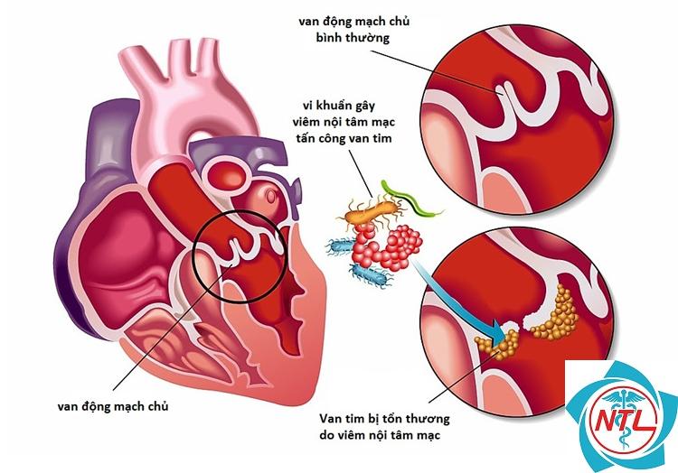 viêm cầu thận do viêm nội tâm mạc