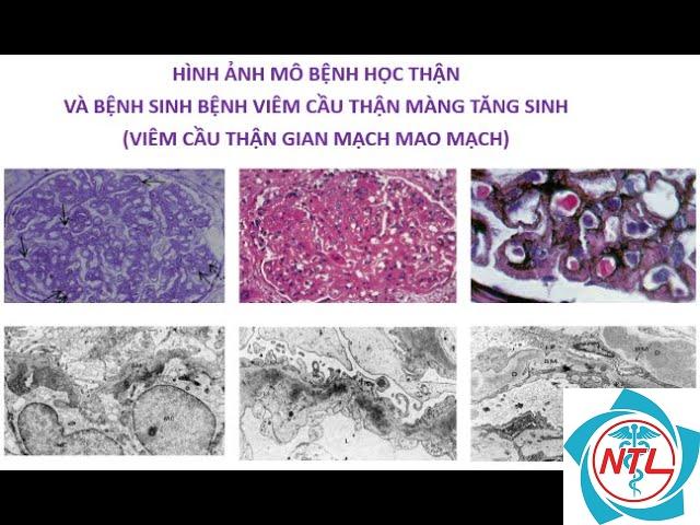 viêm cầu thận tăng sinh gian mạch - Image 1