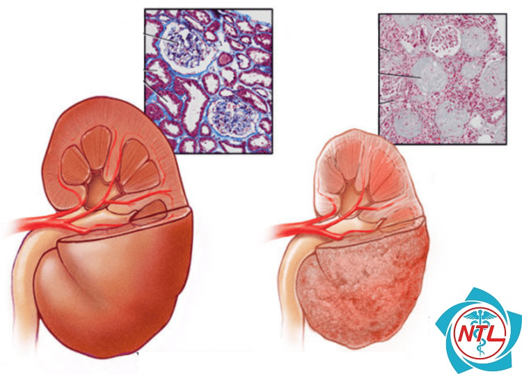 viêm cầu thận xơ hóa - Image 3