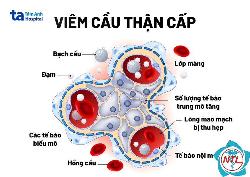 viêm mạch cầu thận - Image 3