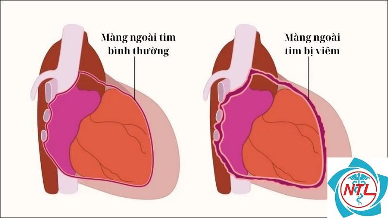 viêm màng ngoài tim do suy thận - Image 3